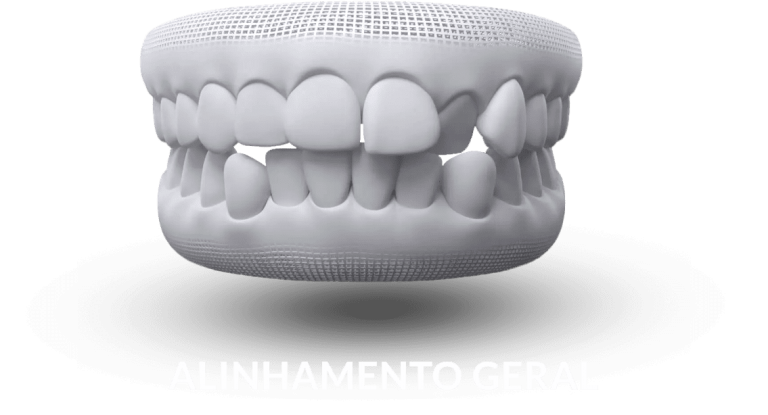 invisalign-alinhamento