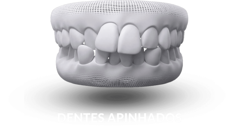 invisalign-dentes-apinhados