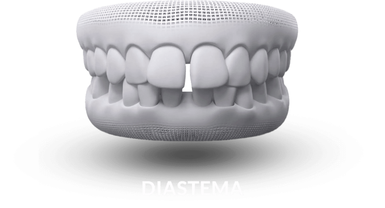 invisalign-diastema