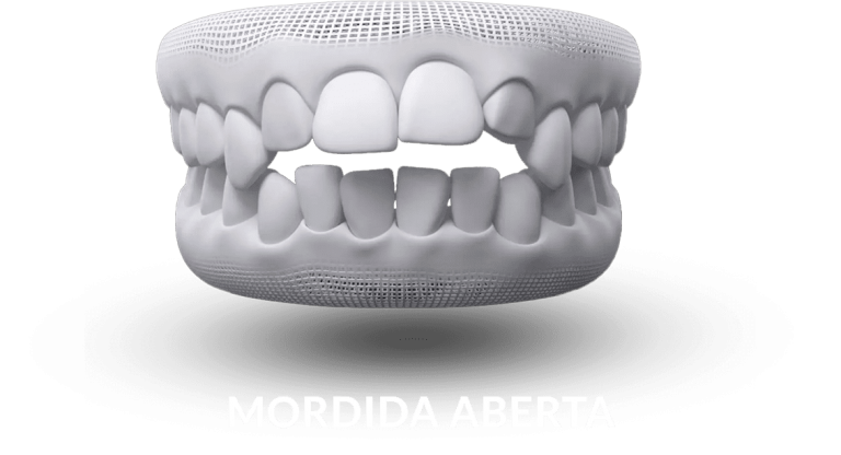 invisalign-mordida-aberta
