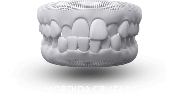 invisalign-mordida-cruzada