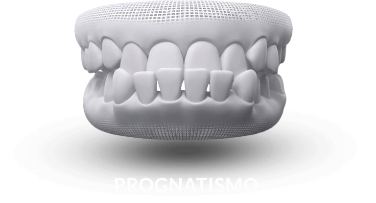 invisalign-prognatismo