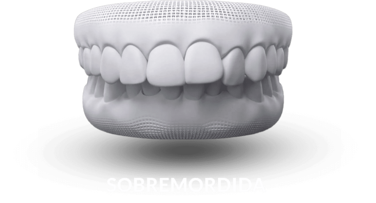 invisalign-sobremordida