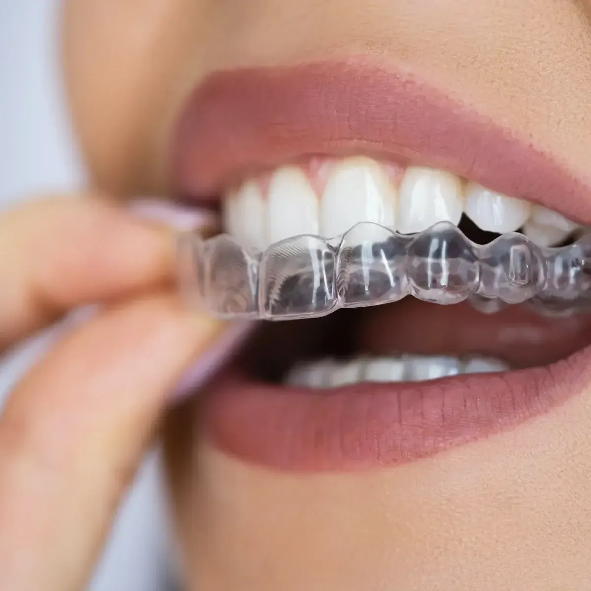 Alinhador transparente Invisalign